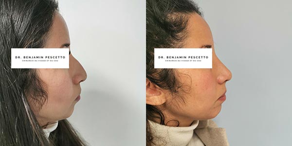 Rhinoplastie médicale